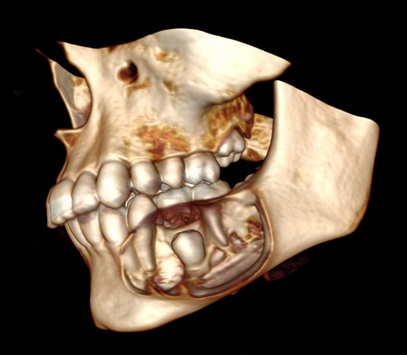 Фолікулярна кіста зуба