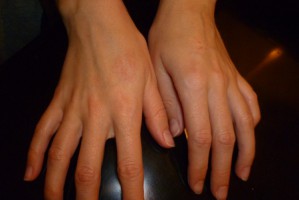 Чому тріскається шкіра на пальцях