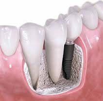 Види імплантації зубів