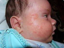 Як лікувати висип на обличчі немовляти