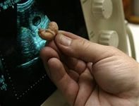 Фармакологічний аборт
