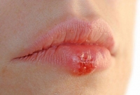 Герпес на губах: лікування мазями