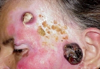 Меланома: ознаки раку шкіри, що починається
