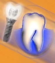 Показання до імплантації зубів