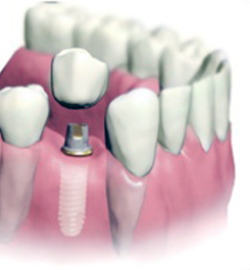 Імплантація зубів під наркозом