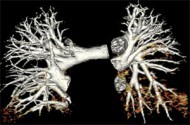 Тромбоемболія дрібних гілок легеневої артерії