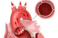 Ущільнення аорти серця