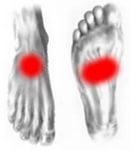 Реактивний артрит колінного суглоба