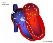 Лікування аритмії серця