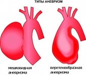 Аневризма черевного відділу аорти