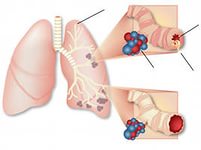 Невідкладна допомога при серцевій астмі