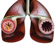 Бронхіальна астма у дорослих