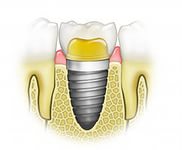 Протезування зубів, імплантація зубів