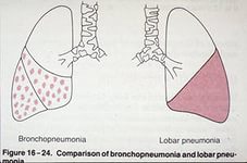 Лікування бронхопневмонії