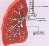 Бронхоектази легенів