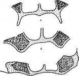 Три типи беззубої верхньої щелепи. Класифікація Шредера