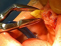 Клініко-біологічні основи протезування беззубих щелеп