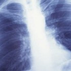 Туберкульоз легень - симптоми, лікування, вогнищевий, інфільтративний і дисемінований туберкульоз легень