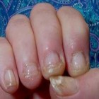 Грибок нігтів на руках - симптоми, лікування, ліки від грибка нігтів на руках