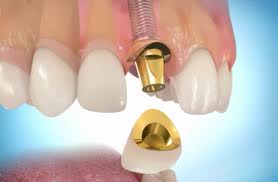 Вартість зубних імплантантів, а також їх види