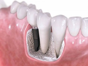 Протезування зубів при парадонтозі