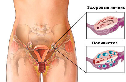 Синдром полікістозних яєчників і вагітність
