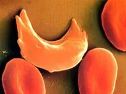 Серповидноклітинна анемія