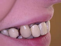 Проблема фіксації зубних протезів