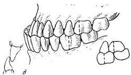 Постановка зубів при прогенічному співвідношенні щелеп