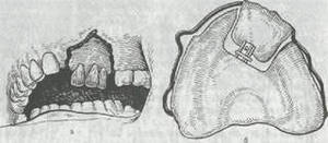 Щелепно-лицева ортопедія
