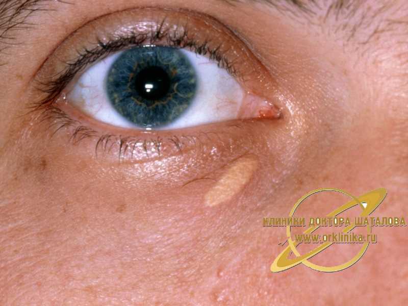 Що таке ксантелазма та як вона виглядає?